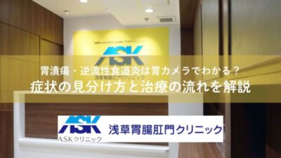 胃潰瘍・逆流性食道炎は胃カメラでわかる？症状の見分け方と治療の流れを解説のアイキャッチ画像