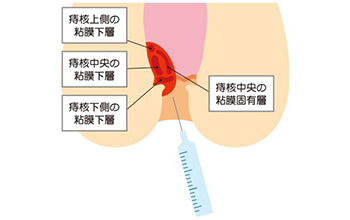 ジオン注射療法(ALTA療法)についてイメージ